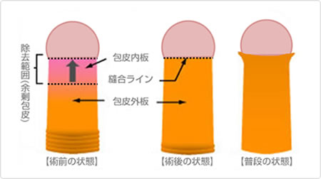 包茎手術の手順イメージ01
