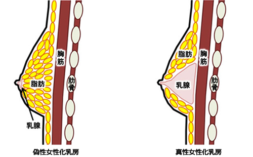 女性化乳房イメージ01