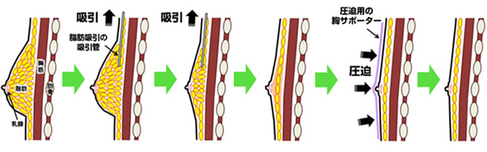 女性化乳房イメージ02