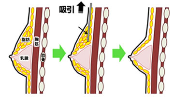 女性化乳房イメージ03