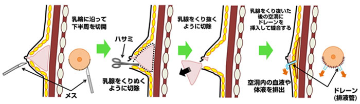 女性化乳房イメージ04