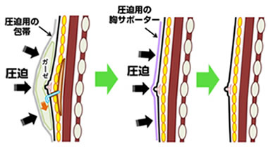 女性化乳房イメージ05