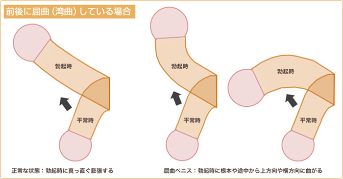 屈曲・湾曲ペニス修正術（曲がり修正）イメージ01