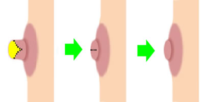 乳頭縮小術イメージ01