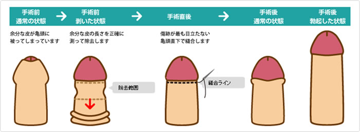 カントン包茎手術のイメージ