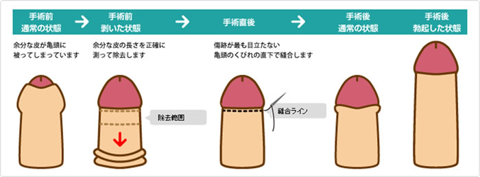仮性包茎手術のイメージ