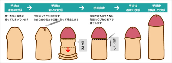 真性包茎手術のイメージ