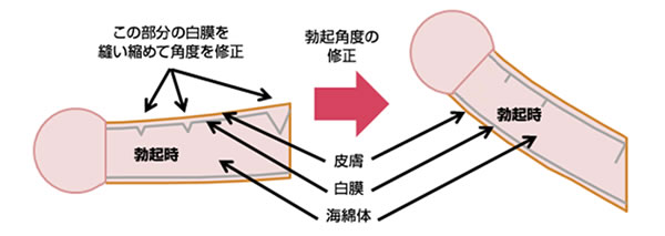 ペニス上反り形成術（勃起角度強化）イメージ02