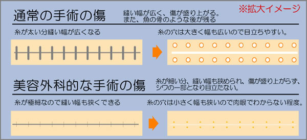 美容外科の縫合法